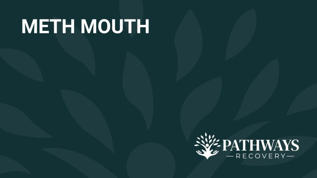 A Simple Guide to Meth Mouth and Treatment